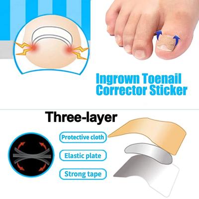 Parches Adhesivos para Corrección de Uñas Encarnadas Tratamiento para Uñas Encarnadas Elevador Parche para Uña del Pie Hebilla de Corrección Lima Empujador de Cutículas