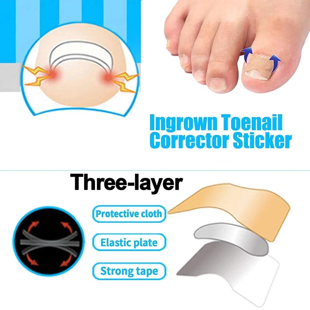 Ingrown Toenail Correction Patch Stickers Ingrown Toenail Treatment Lifter Toe Nail Patch Correction Buckle File Cuticle Pusher