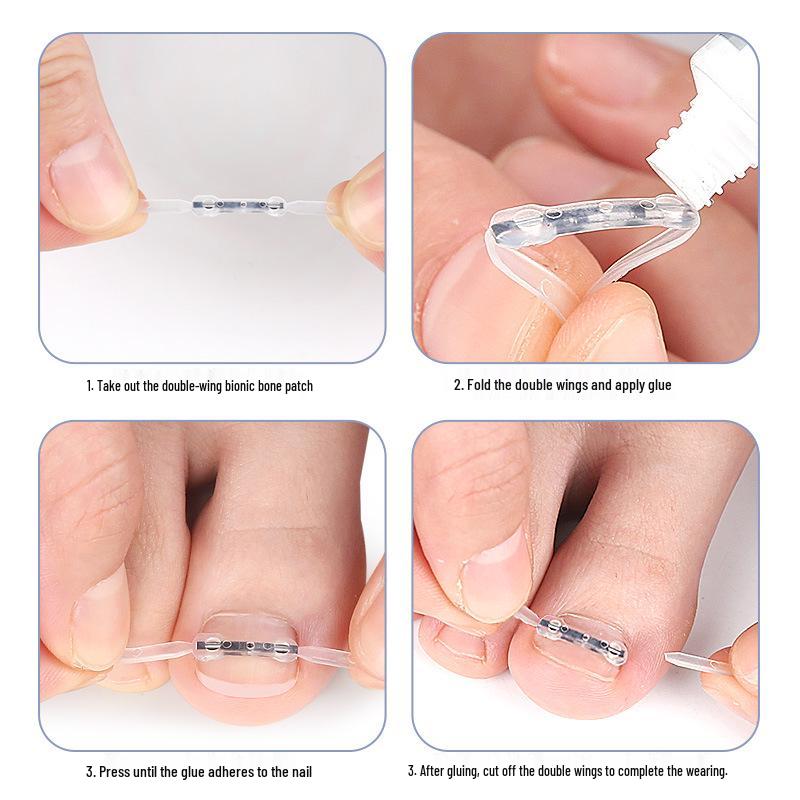 Double-Wing Ni-Ti Alloy Bionic Bone Patch for Ingrown Toenail Correction