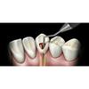 GDC Root Canal Plugger Luks - (.50mm) (.75mm) RCP5/7 #3