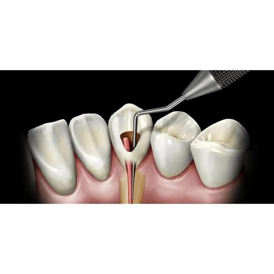 GDC Root Canal Plugger Luks - (.50mm) (.75mm) RCP5/7 #3