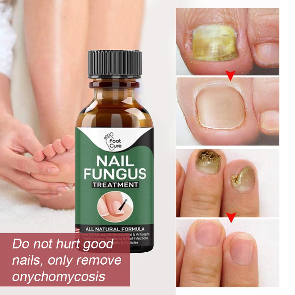 50ML Nail Treatment Solution Nail Repair Liquid Accelerate Metabolism Onychomycosis Treatment
