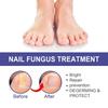 Ouhoe Nail Repair Solution Thickening Treatment For Ingrown Nails And Fungal Issues