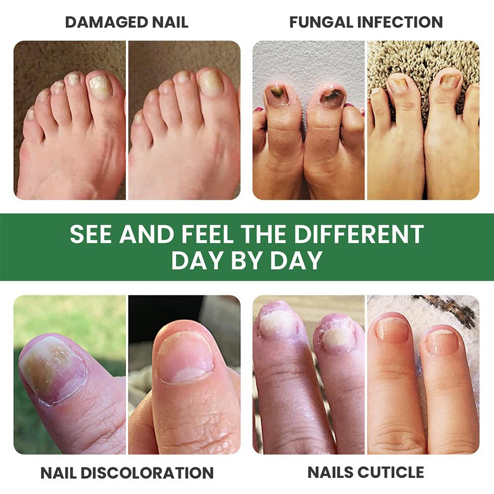Sumifun Nail Care Ointment With Soothing Formula For Foot And Hand Maintenance