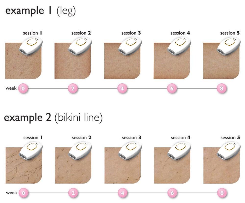 2023 Unisex Laser Hair Removal Device - Popular Hot Selling Model