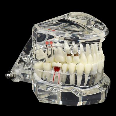Removable Oral Restoration Model Pathological Tooth Model Glass Teaching Implant Active Tooth Model