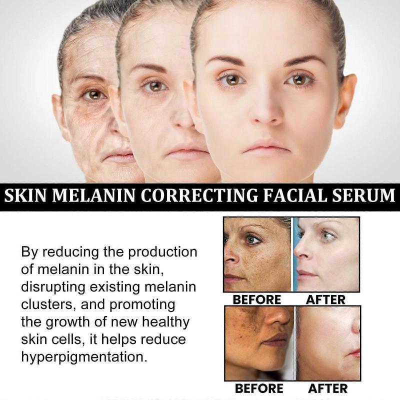 Melanin Correcting Facial Serum, Fade Dark Spots Anti Freckle Melasma Remover Lightening Pigment Blemish Vitamin C Face Essence