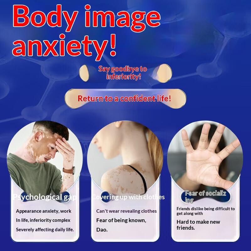 Cream for Uneven Skin Tone: Works To Restore Skin Affected by Vitiligo