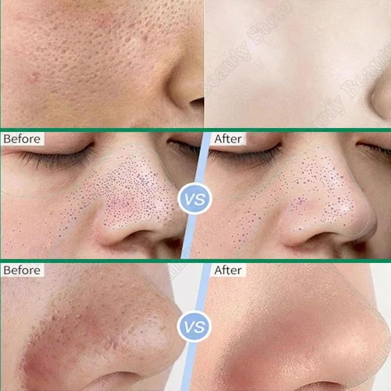 Crema Purificante Pori con Acido Salicilico Restringe i Pori Rimuove i Punti Neri Acne Illumina Idrata Pelli Lisce Cura della Pelle Prodotti Coreani