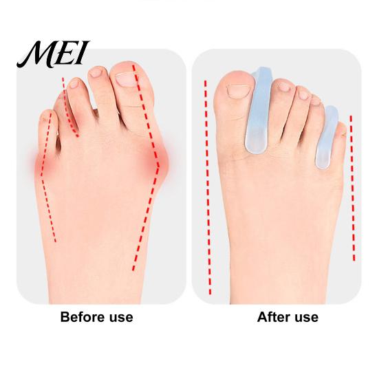 Flexible Toe Spacer 2PCS Gel Separator, Soft Flared Spreader Straightener, Ultra-Thin Non-Slip A-shaped Separator Comfortable Bunion Corrector,