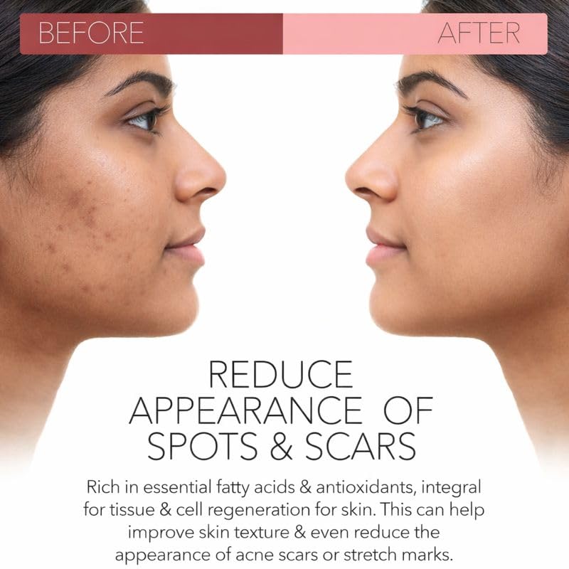 Rosehip Oil for Skin | Rosehip Seed Oil for Face | 100% Pure & Natural Essential Oil - 15 ML