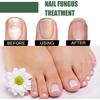 Eelhoe Nail Repair Liquid For Thick Toenails And Fungal Infections 50ml Ideal For Healthier Feet