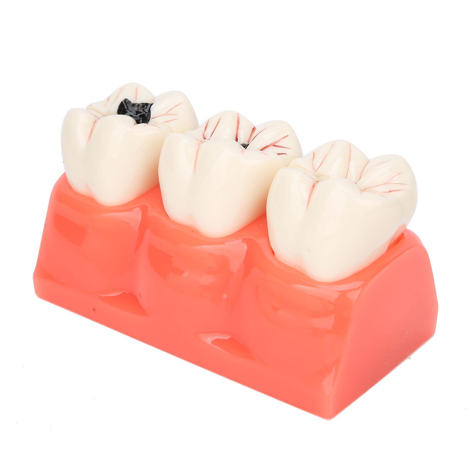 

Модель зубного кариеса Модель демонстрации зубного кариеса Модель-симуляция Съемная модель зубов