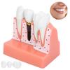 Model zubů Analýza zubního implantátu Demonstrační model korunkového můstku Model zubu