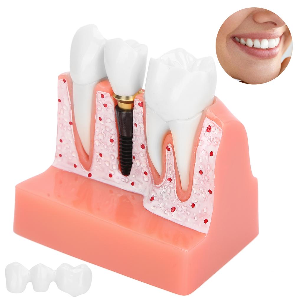 Model zubů Analýza zubního implantátu Demonstrační model korunkového můstku Model zubu