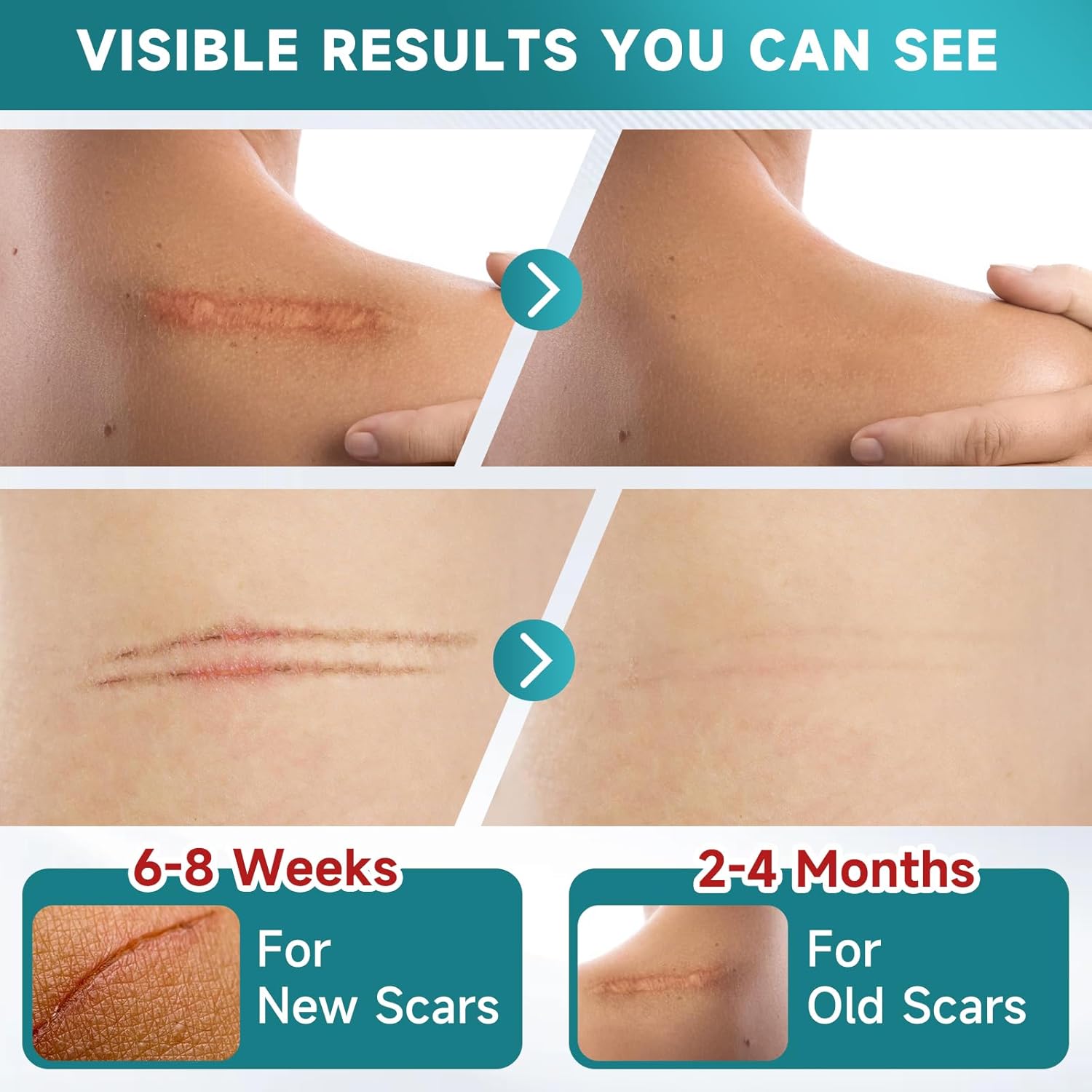 Silicone Scar Sheets, Silicone Scar Tape(1.6” x 120” Roll-3M), Scar Removal Away Strips for Surgical Scars, Keloid, C-Section, Burn et
