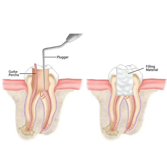 GDC Root Canal Plugger Luks -(.50mm) Rcpl2 #3