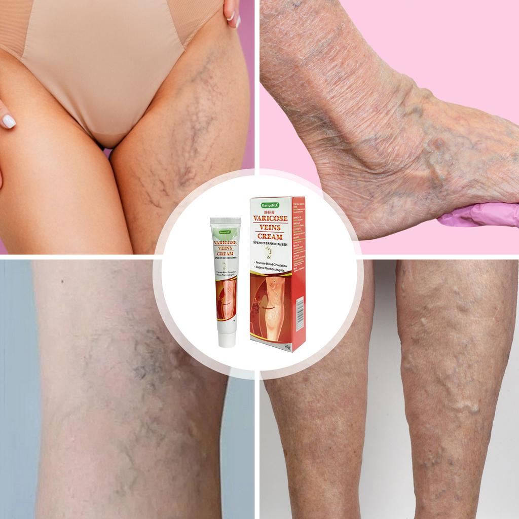 Varicose Veins Paste, Remove Varicose Veins, Varicose Veins Curing For Legs, Spider Veins Removal For Legs, Varicose Vein Renovate Paste