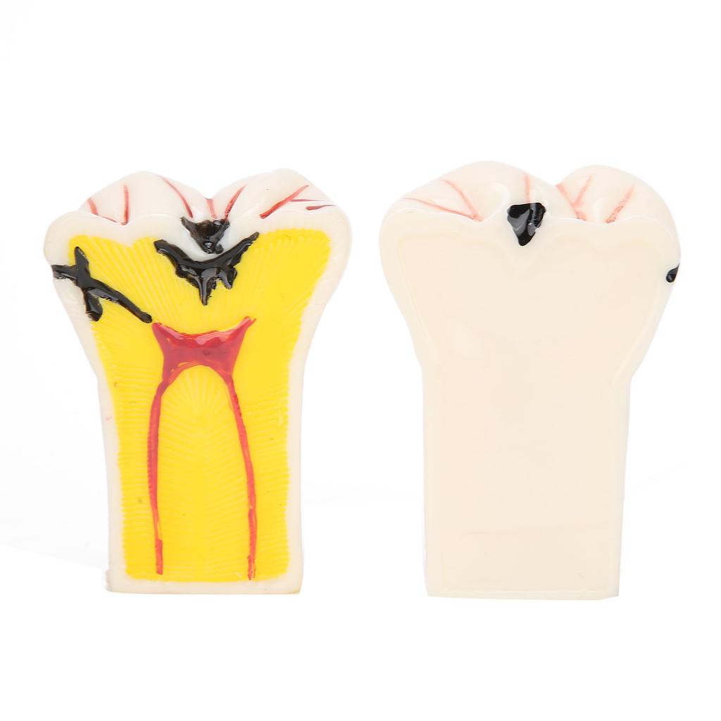 Dental Caries Model Tooth Decay Demonstration Model Simulation Detachable Teeth Model