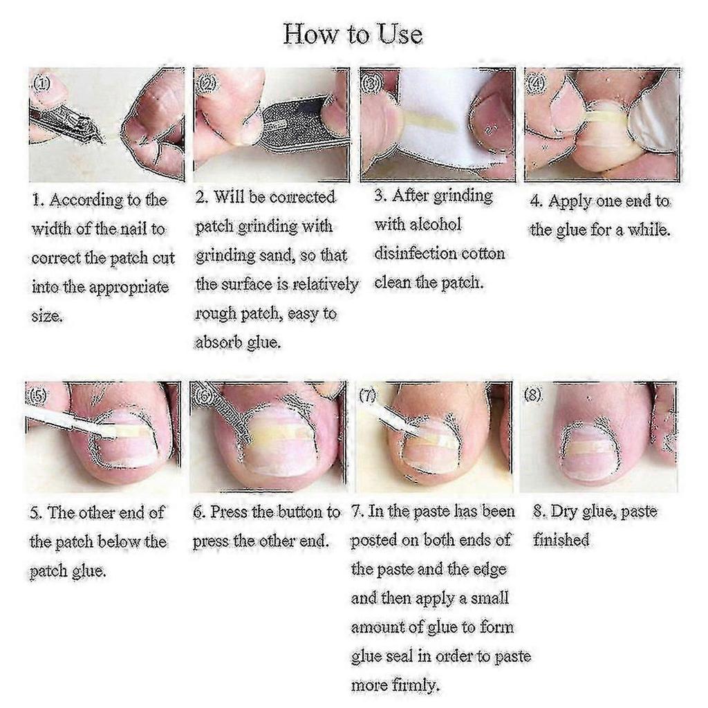 10Pcs Ingrown Toenail Corrector Curved Clip for Paronychia Relief Thick Nails