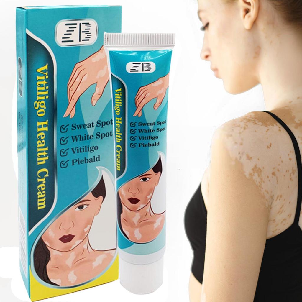 ZB Powerful Cream Treatment for Vitiligo and Skin Discoloration Reduce White Spots, Improve Skin Pigmentation