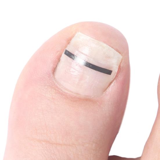 Yousheng Titanium Alloy Ingrown Toenail Corrector Kit for Curved Nail Repair Ingrown Toenail Treatment Tool Toe Nail Straightener