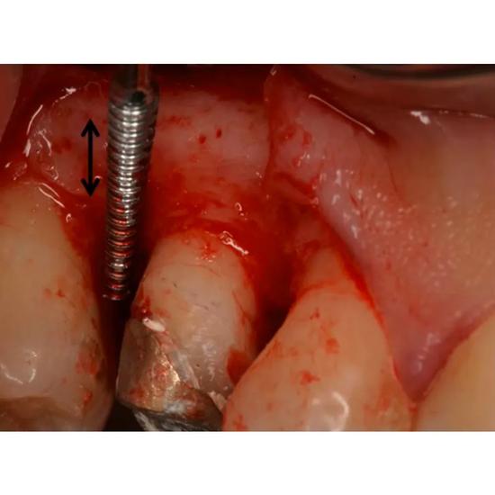 GDC Periodontal Sugarman Bone File#1 (Fs3/4s)
