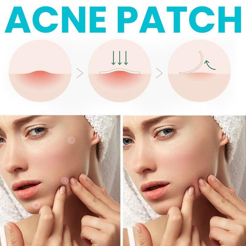Ouhoe Acne Patches Gentle And Non-irritating Hydrocolloid Stickers For Flawless Skin 72pcs
