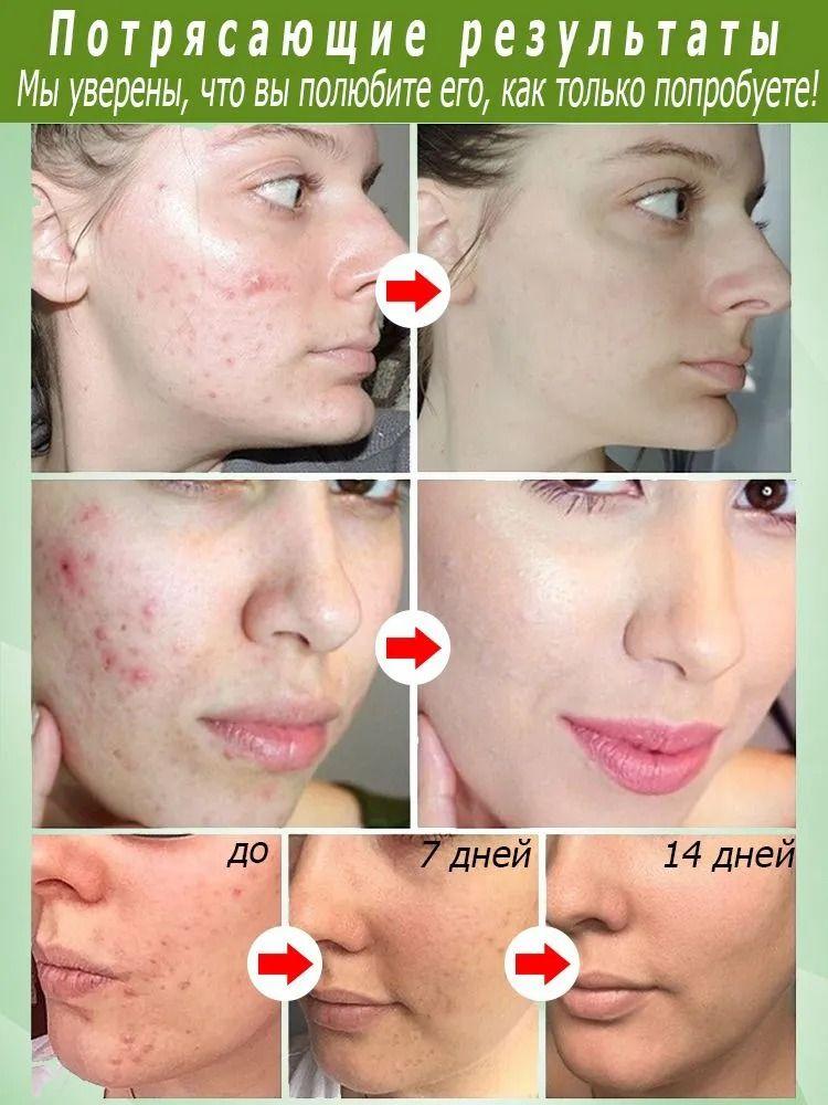 Cream for facial inflammation, acne and blackheads, for oily and problem skin, suitable for teenagers and adults, 15 g