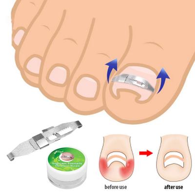 Ingrown Toenail Corrector Toenail Correction Treatment Tool Foot Nail Care Tool Orthotic Nail
