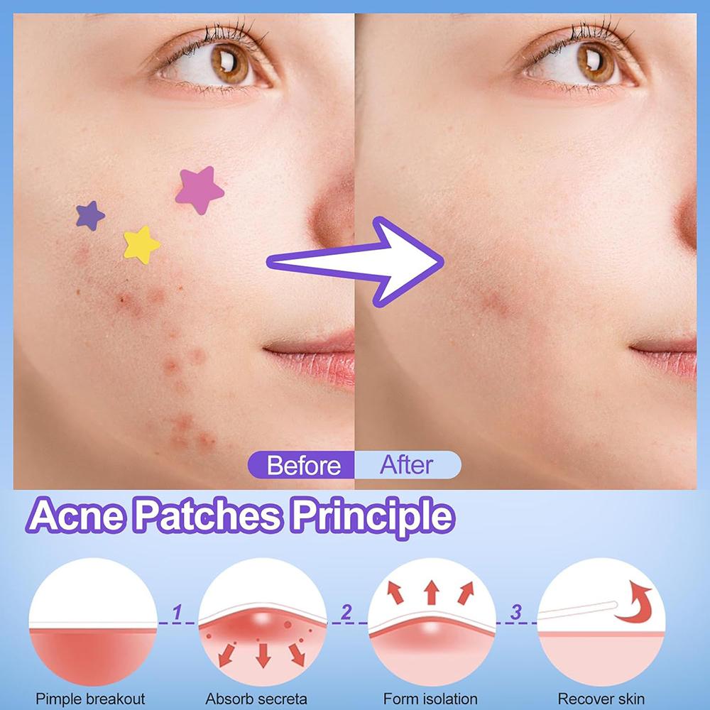 Colorful Star Acne Patch Improve Women Skin Hydrocolloid Acne Tool Invisible Acne Cover Pimple Patch Skin Care Tools