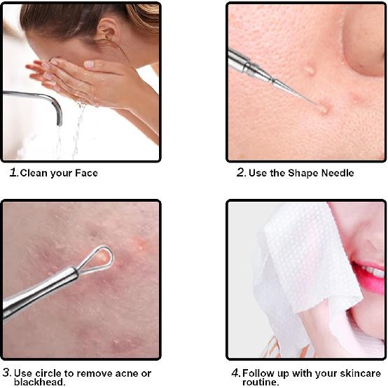Professional Facial Milia Removal and Whitehead Extractor & Lancet - Double Ended Circle Loop & Sharp Needle Pimple Popper Tool - 2-in-1 Blackhead &