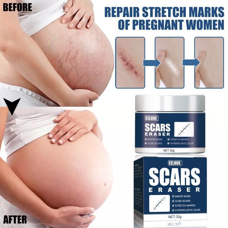 Effective Eelhoe Scar Repair Gel For Reducing Surgical And Burn Scars On Skin