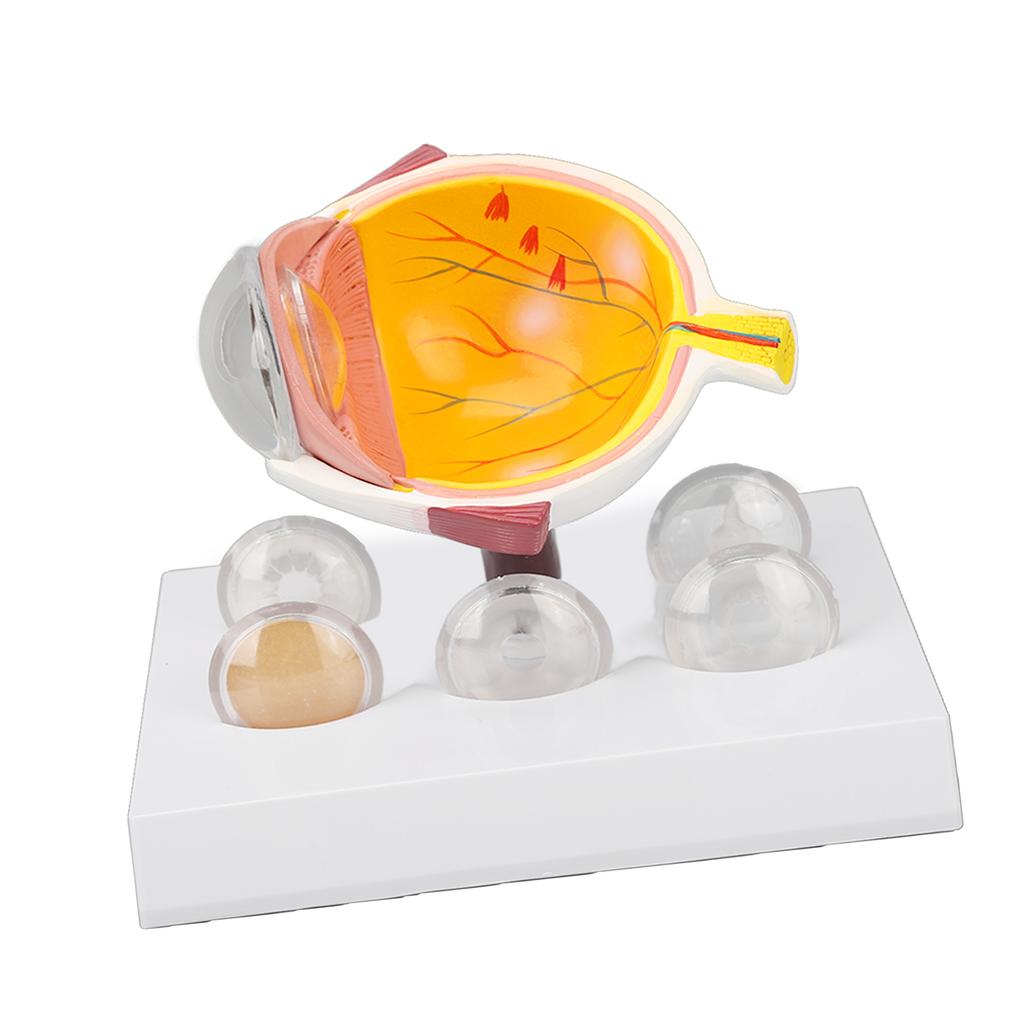 Eyeball Lesion Model Enlarged Human Eye Anatomical Model Accurate Shows Optic  Cornea  Lens  Eyeball Model
