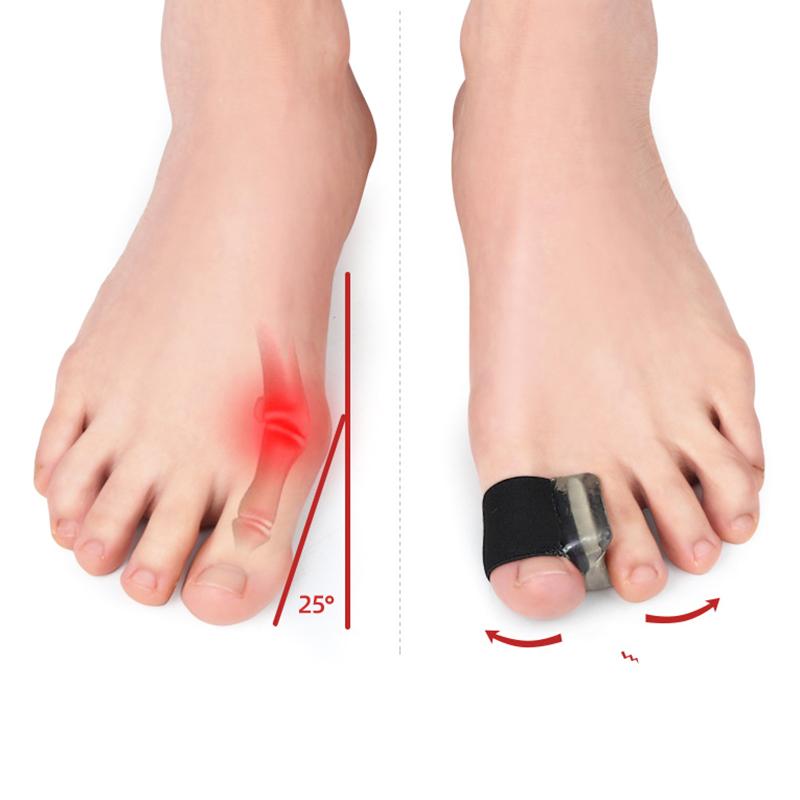 1 Paar Zehenspreizer Einlegesohlen Ring Trennung Korrekturpolster Fußpflege Orthopädischer Fuß Zehe Korrigieren