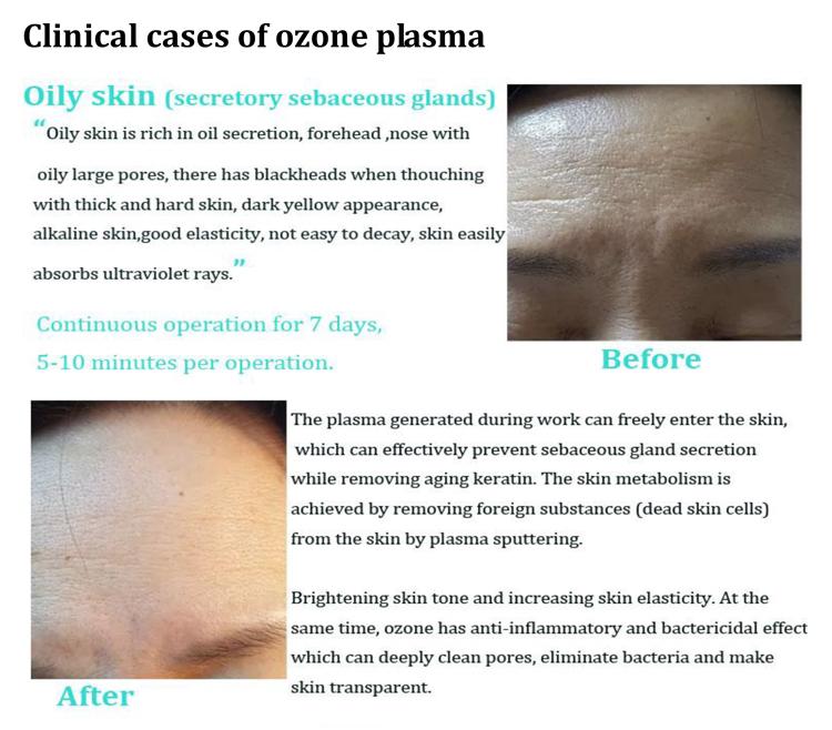 Profesionální ozónové plazmové pero pro zmírnění stárnutí pleti, omlazení pleti, bělení, léčbu akné, plazmové pero