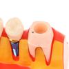 Dental 4 Times Implant Teeth Model Analysis Crown Bridge Demonstration Removable Model Dentistry Study Training Teaching Model