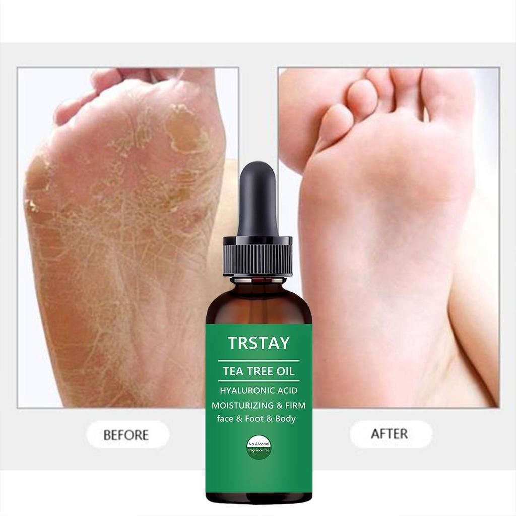 Fotbehandling:  Botanisk fotkrem Fuktighetsgivende fotpleieessens for tørr hud, sprukne hæler, sterk helbredende kraft, soppdrepende