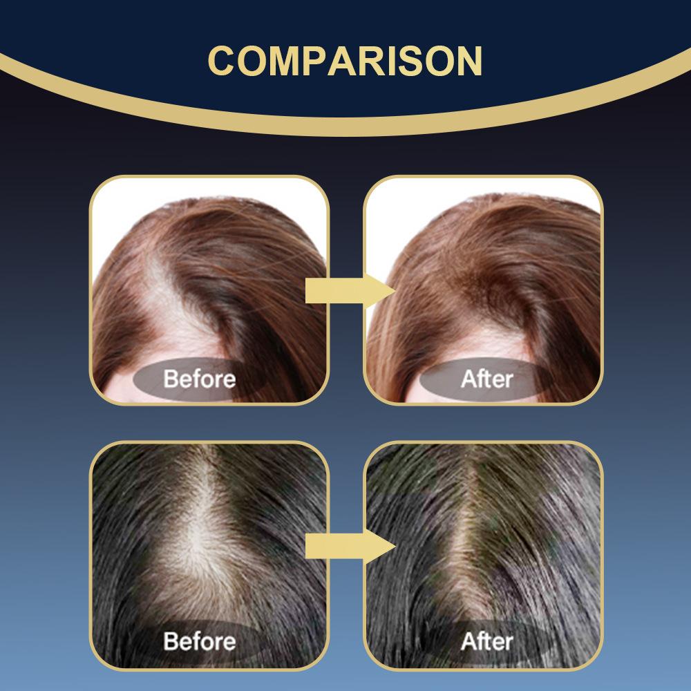 Sumifun 30 ML Ginger Hair Care Essence Spray,Hair Growth Essence Oil,Rapid Hair Growth Hair Nutrient Solution Scalp Care Repair Damaged Hair