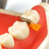 Coins dentaires en plastique interproximaux pour dents de premier choix avec matrice dentaire en acier inoxydable Outil pour matériaux dentaires