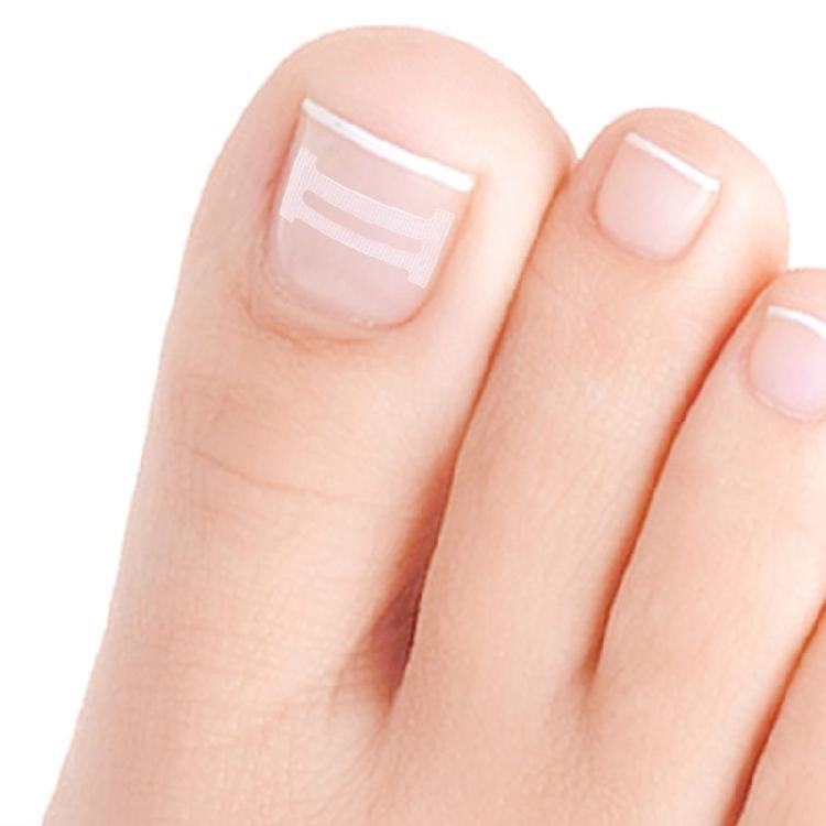 10 Pezzi Strisce Correttive per Unghie Incarnite per Sollevamento Delicato e Allineamento dell'Unghia Strumenti per Pedicure da Salone o per Uso Domestico per Adulti
