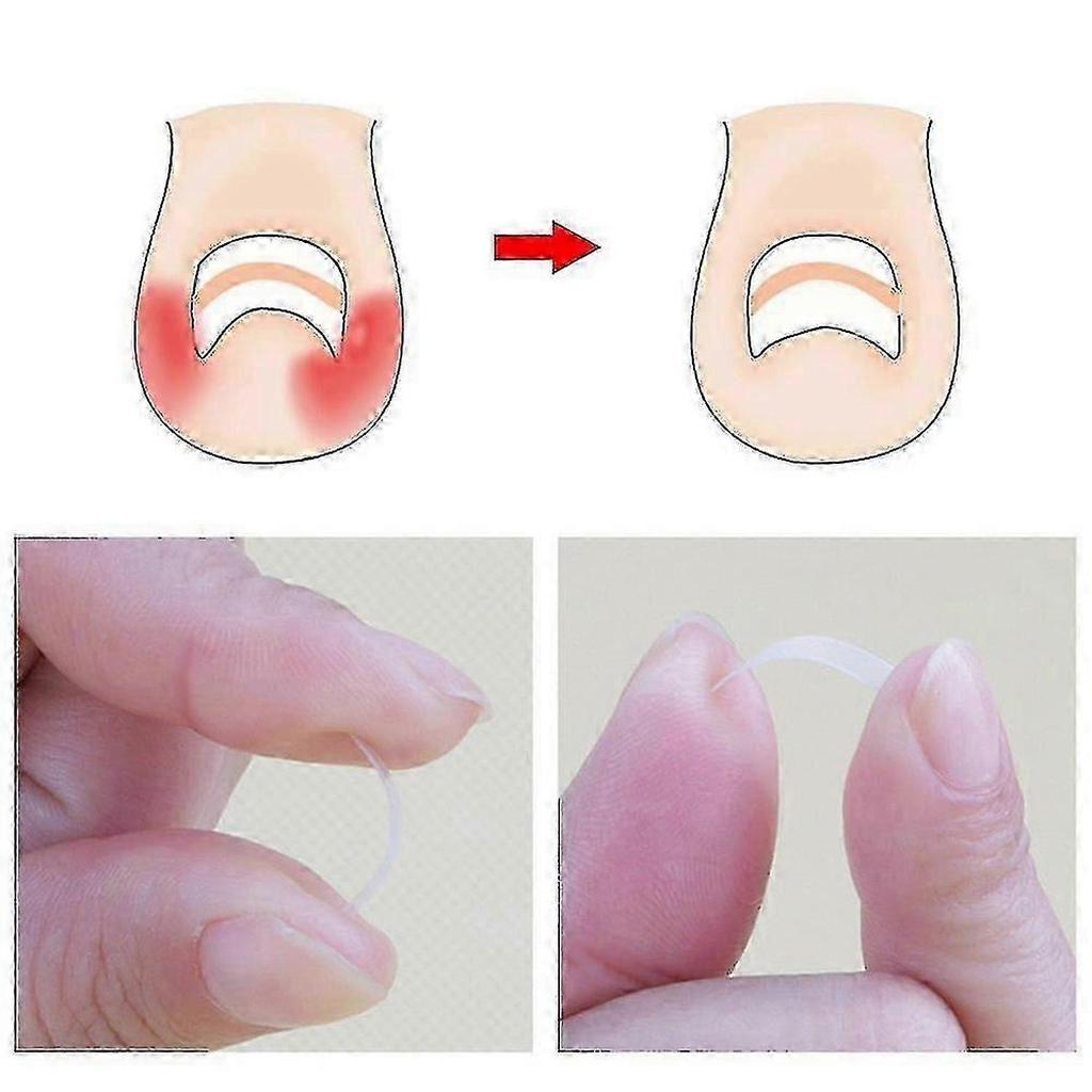 10Pcs Ingrown Toenail Corrector Curved Clip for Paronychia Relief Thick Nails