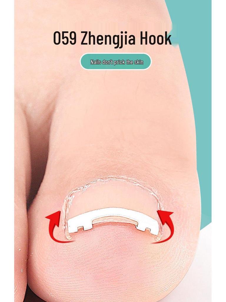 Nickel-Titanium Ingrown Toenail Corrector: Invisible, Wearable Nail Hook for Pain Relief
