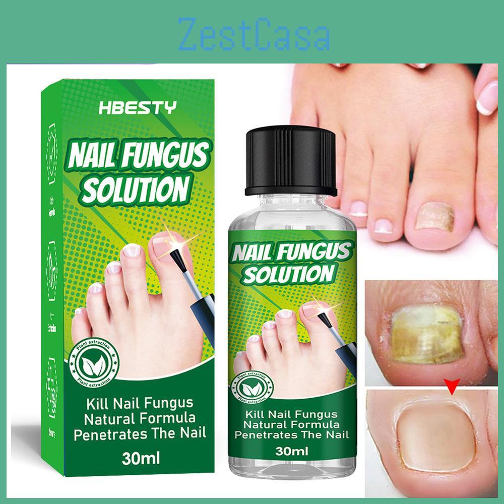 Hbesty Herbal Nail Fungus Treatment Liquid For Effective Foot Care And Healing