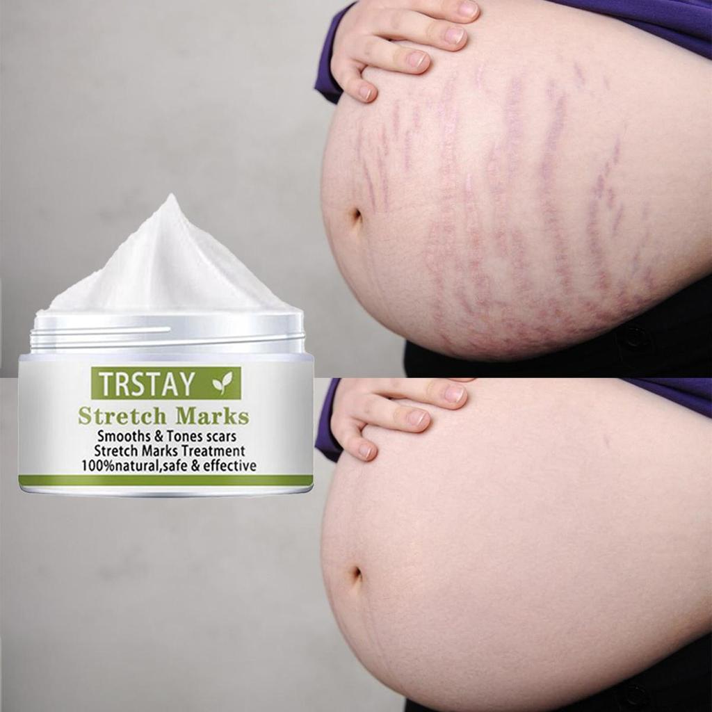 Moisturizing care cream, stretch mark repair cream