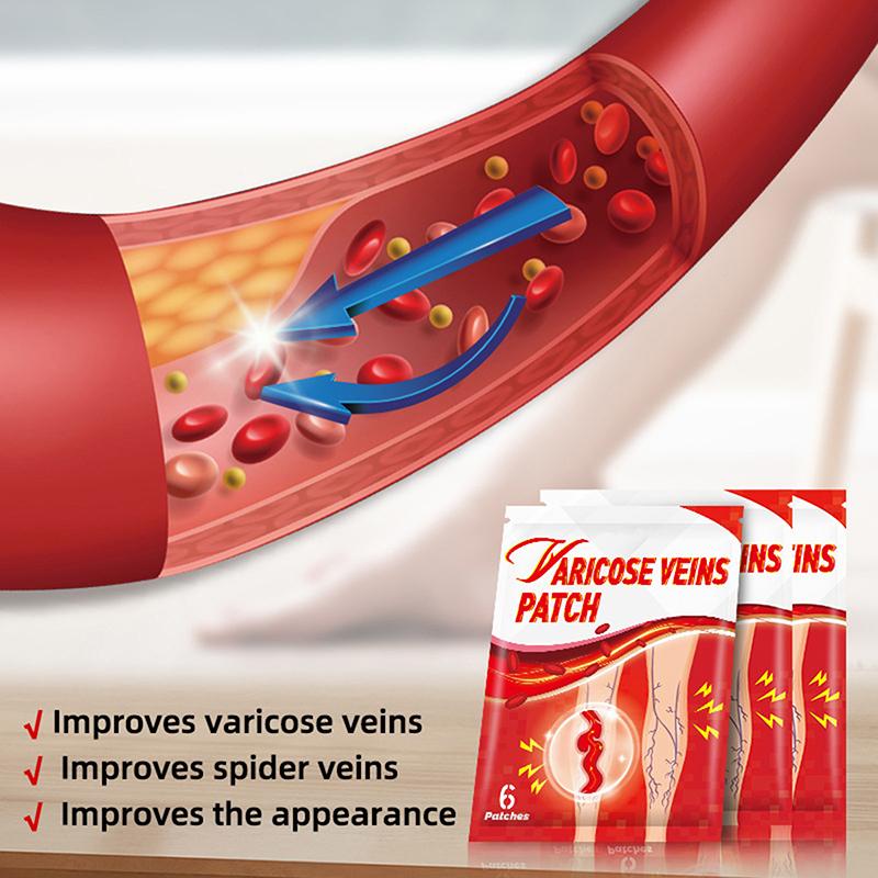 6 пластырей/упаковка Пластырь для наружного применения от варикозного расширения вен Пластырь Shu Ning Дышащий, долгодействующий, успокаивающий, пластырь для лечения сосудистых звездочек на ногах