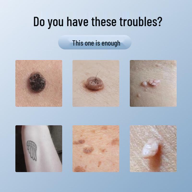 Portable Laser Picosecond Pigment Removal Pen