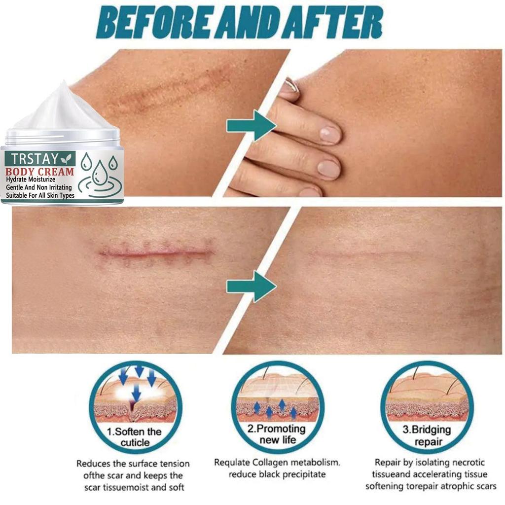 Whitening and Scar Removing Cream for Removing Scars and Acne, Anti-inflammatory and Repairing Damaged Skin, Even Skin Tone, Moisturizing Cream