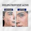 3 STÜCK A-313 Vitamin A Retinol Creme A~313 Retinol Anti-Aging Creme für das Gesicht, reduziert Poren & Falten, behandelt Akne & dunkle Flecken
