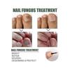 Extra Strong Nail Fungus Treatment, Best Nail Repair Stop Fungal Growth Effective
